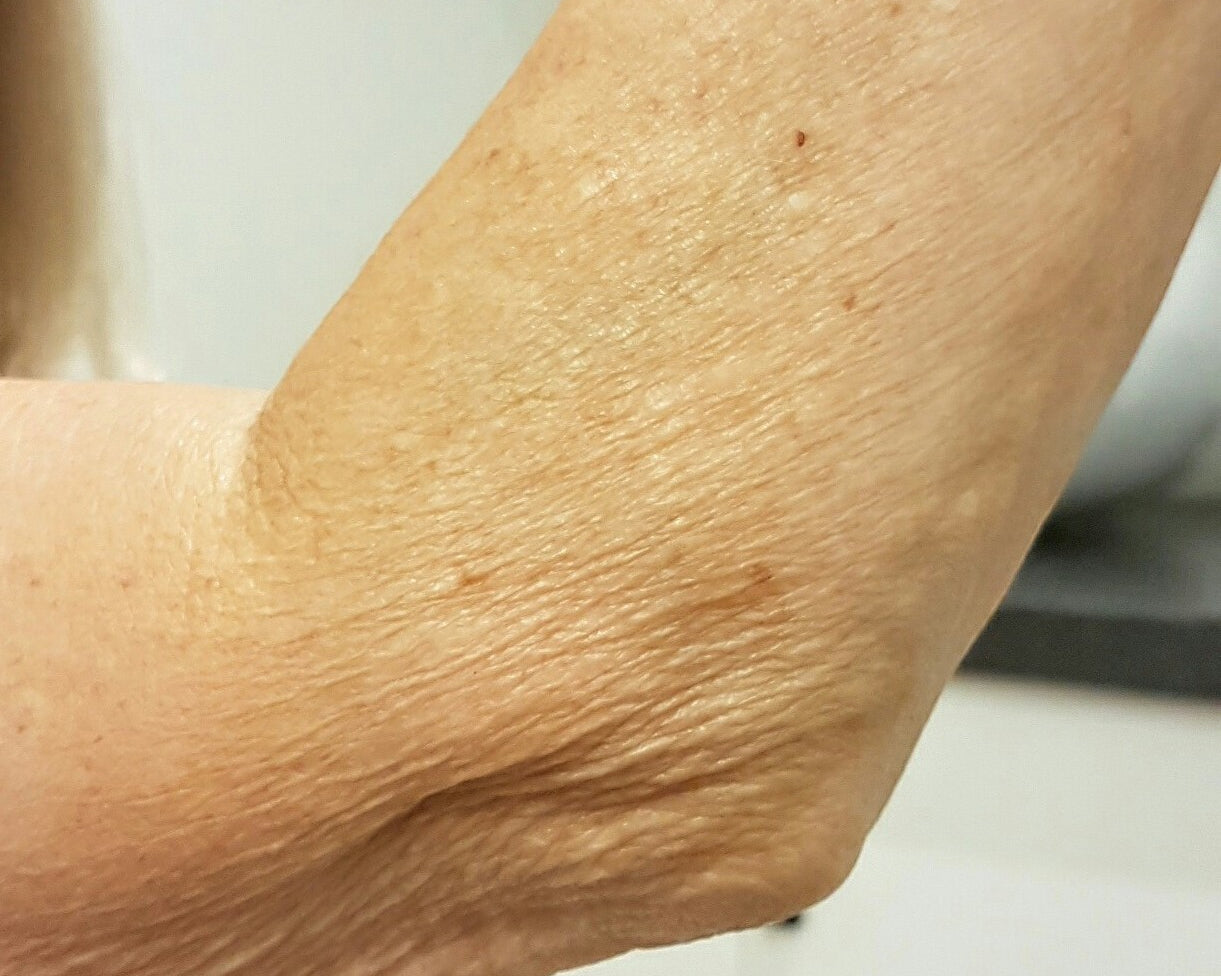 Arm with crepey skin
