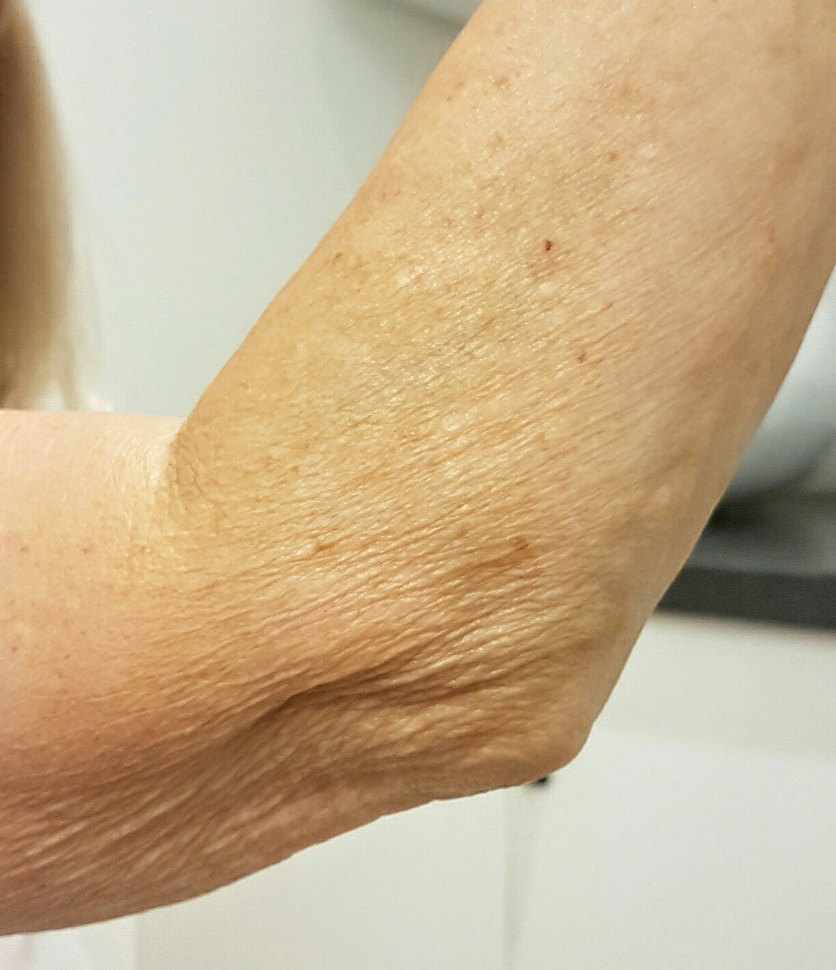 Arm with crepey skin